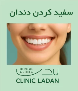 لیچینگ دندان در کلینیک لادن اطلس مال تهران